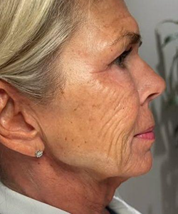 Before of Dermal Fillers