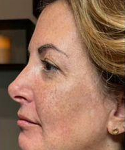 Before of Collagen stimulating Fillers and Neurotoxins