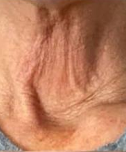 Before of HA fillers, Collagen stimulating fillers & neurotoxin combo