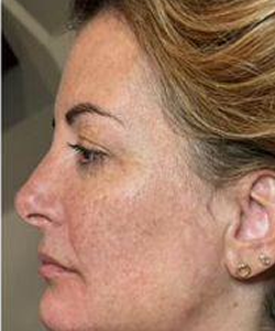 After of Collagen stimulating Fillers and Neurotoxins