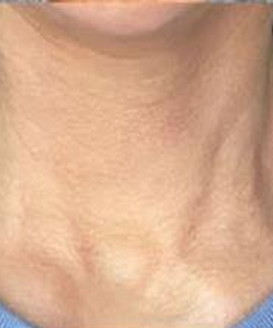 After of HA fillers, Collagen stimulating fillers & neurotoxin combo