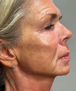 After of Dermal Fillers